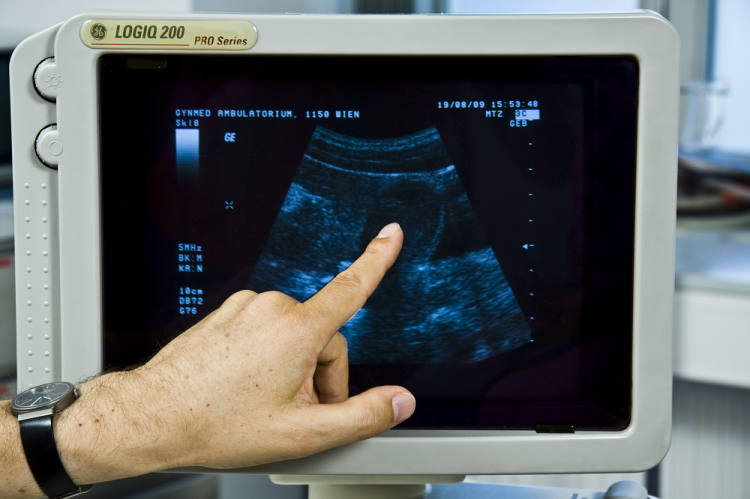 Tlmočníčka na interrupčnej klinike: Žiadne nožičky a ručičky pri potrate neuvidíte