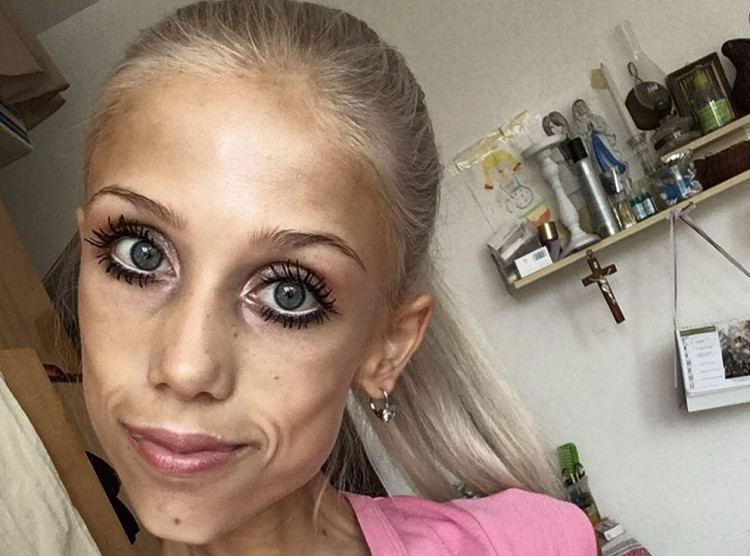 Natália Hricová zomrela na anorexiu. Mala 23 rokov a 20 kg